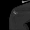 SPORK, NICO - 22.03.1976 - 02.08.2022 - CT obere Extremität - 17:59:07